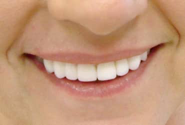 dental crowns, dental bridges, porcelain veneers