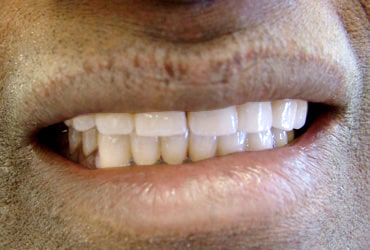 dentures, porcelain crowns