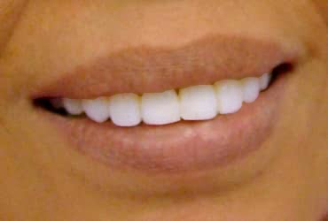 orthodontic, composite veneers