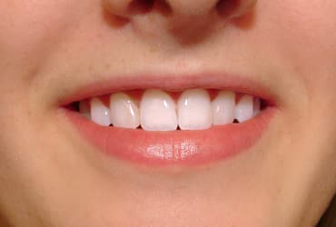 orthodontic, composite veneers