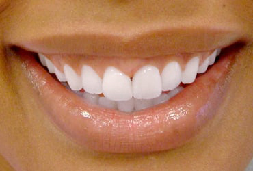 orthodontics, veneers, gum recontouring