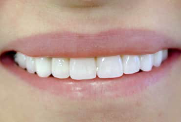 porcelain veneers, dental bridges, dental crowns