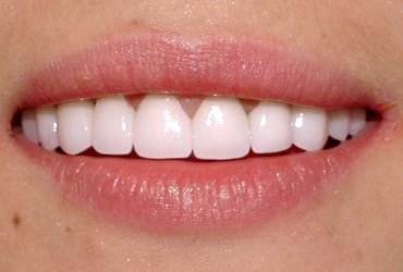 porcelain veneers, bridges, gum recontouring