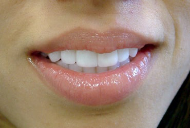 porcelain veneers