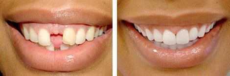 Smile Makeover Before & After At Bloor West Smiles