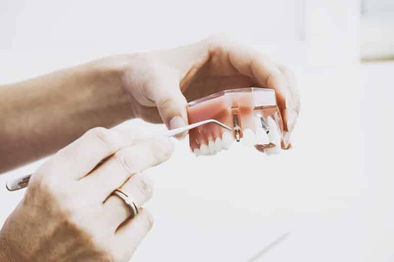 Facts about Dental Implants