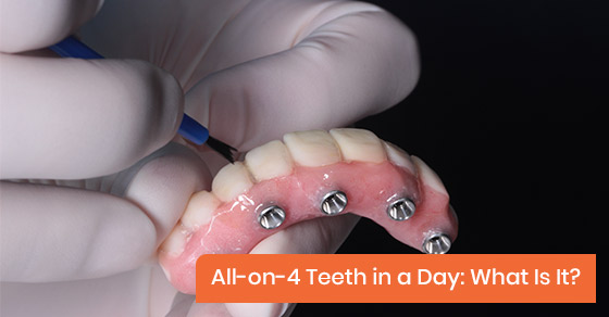 All-on-4 Teeth In A Day: What Is It?