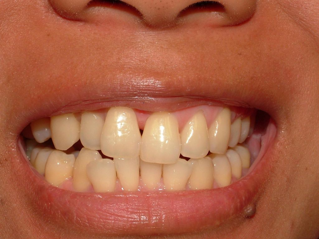 orthodontic, composite veneers