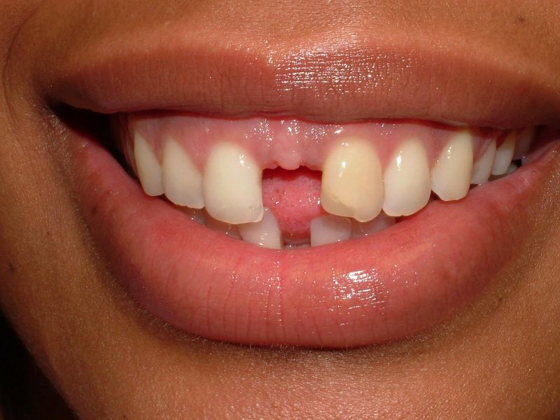 orthodontics, veneers, gum recontouring