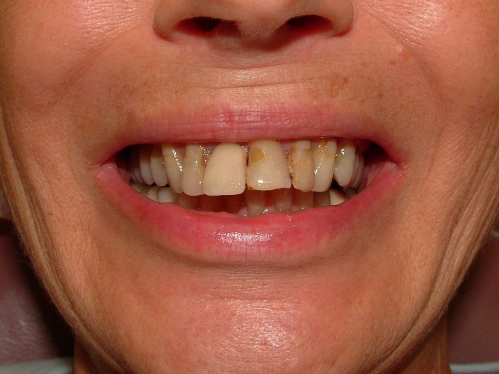 porcelain crowns, periodontal surgery