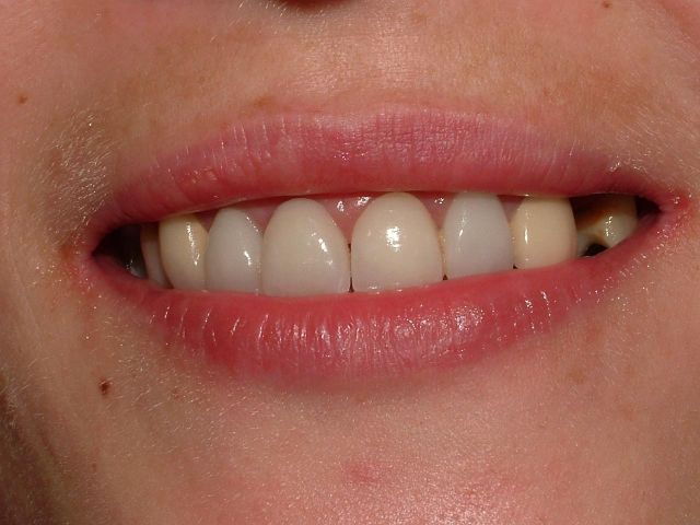 porcelain veneers, bridges, gum recontouring