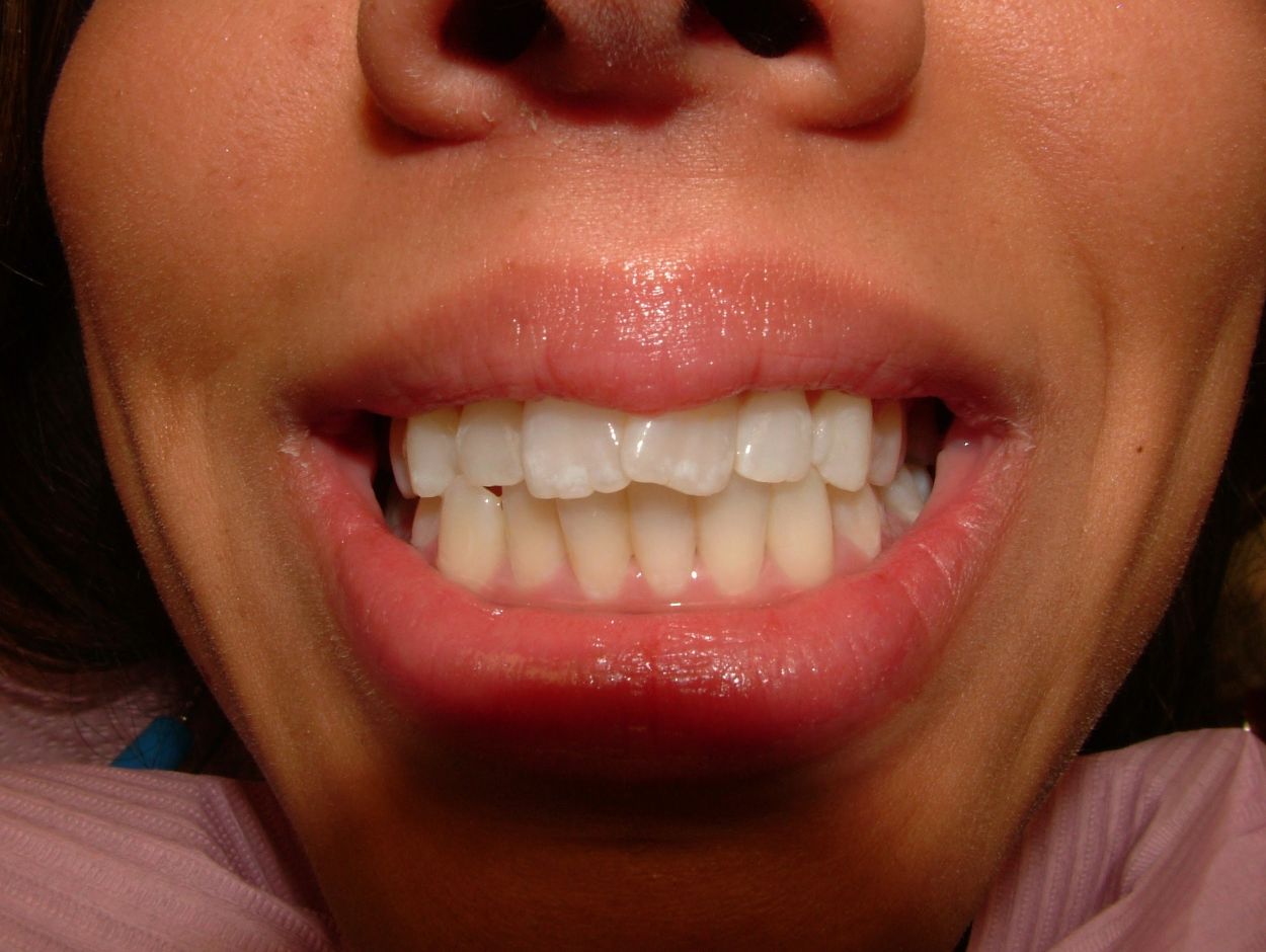 porcelain veneers