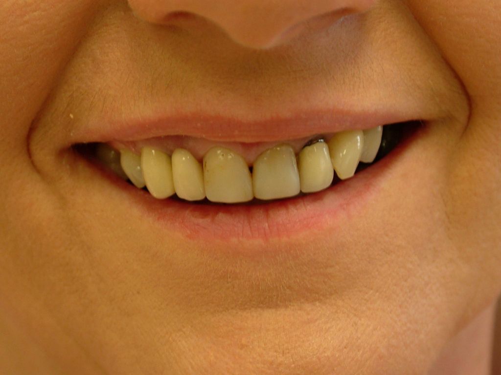 dental crowns, dental bridges, porcelain veneers