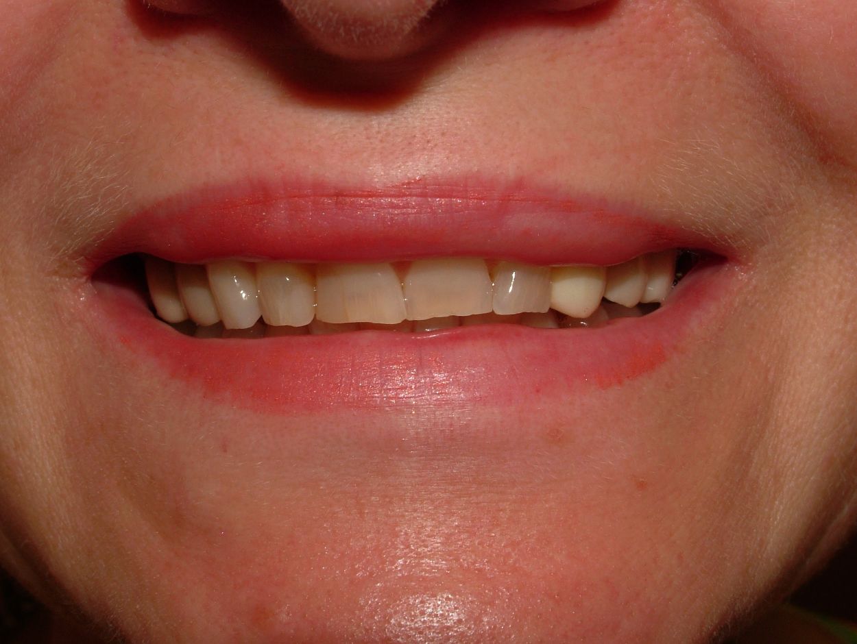 porcelain veneers, dental bridges, dental crowns