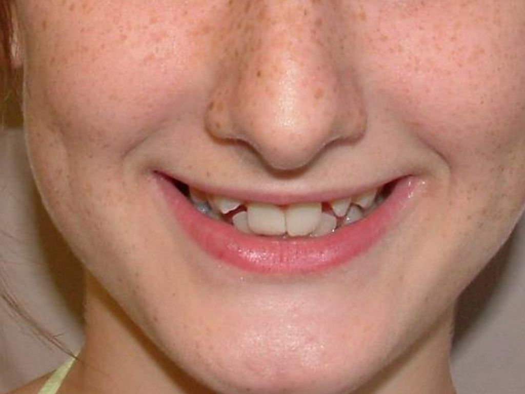 orthodontic, composite veneers