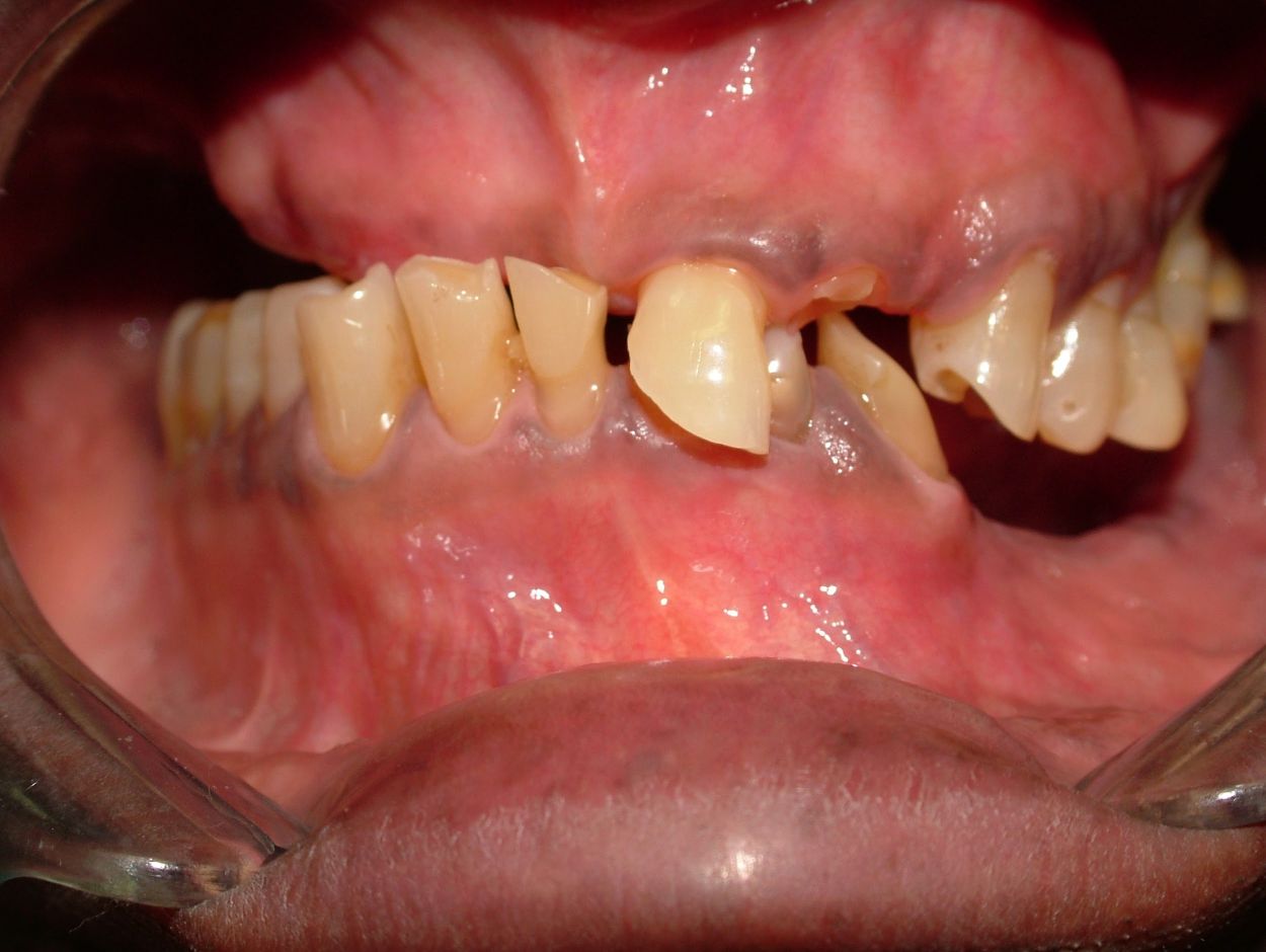 dentures, porcelain crowns