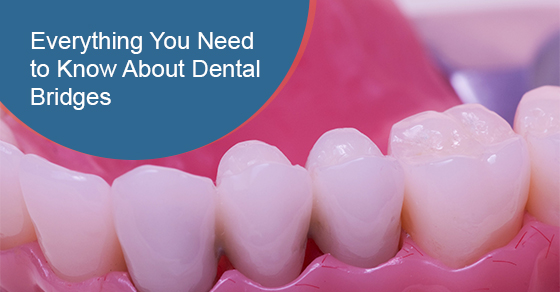 Everything You Need to Know About Dental Bridges