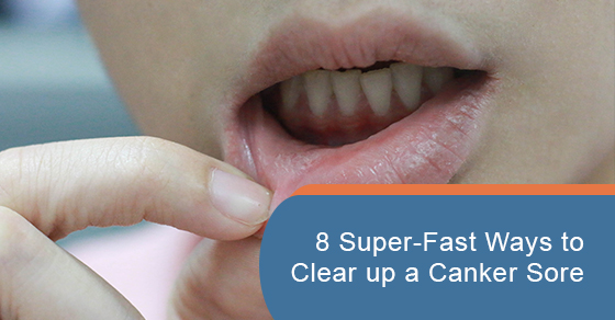 Super-fast ways to clear up a canker sore
