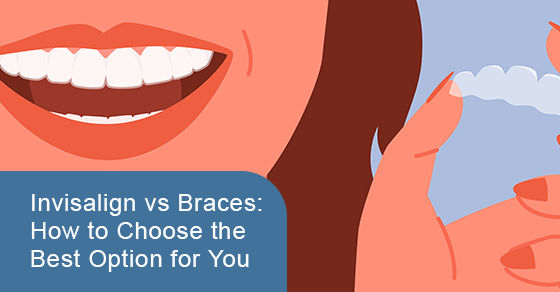 Invisalign vs. Braces: How to Choose the Best Option for You