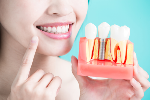 All On 4 Dental Implants Toronto