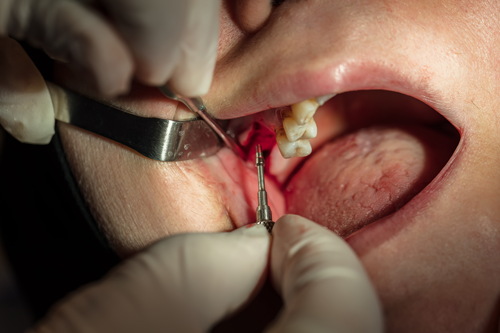 Dental Bone Grafting Toronto