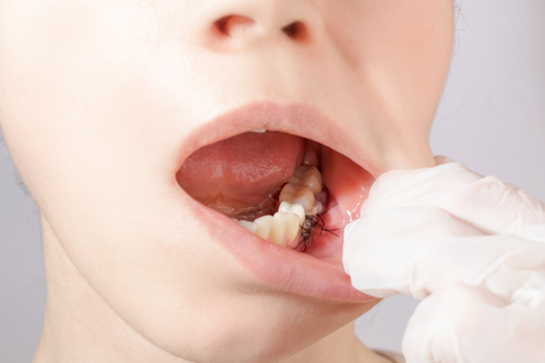  Gum Graft Surgery